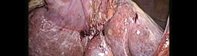 Dilated common bile duct