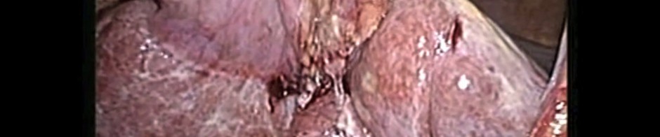 Dilated common bile duct