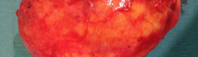 Schawnoma retroperitoneal