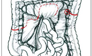 coloplastia transversa isoperistáltica