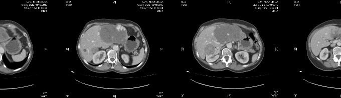 hemangioma