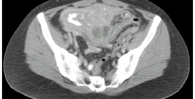 malrotación intestinal