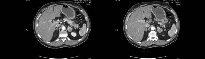 pancreas