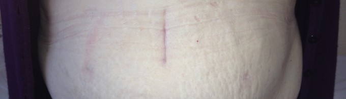 Cicatriz gastrectomía lap 3