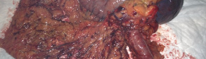 Esplenopancreatectomía distal con gastrectomía total y colectomía 1