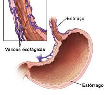 varices esofagicas