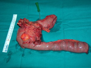 Tumor duodenal 1