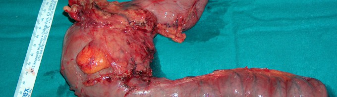 Tumor duodenal 1