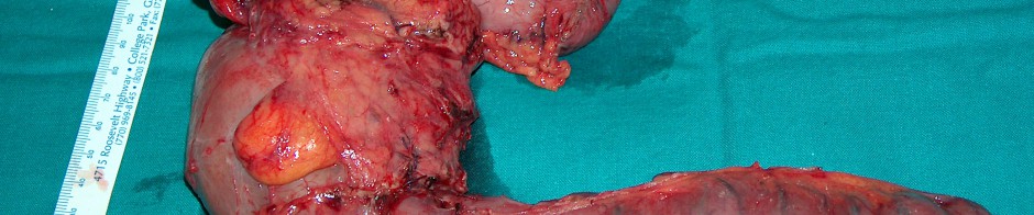 Tumor duodenal 1