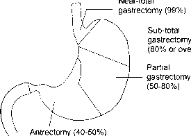 8159_56_57-subtotal-gastrectomy