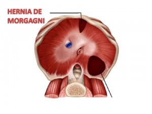 hERNIA MORGAGNI.tif