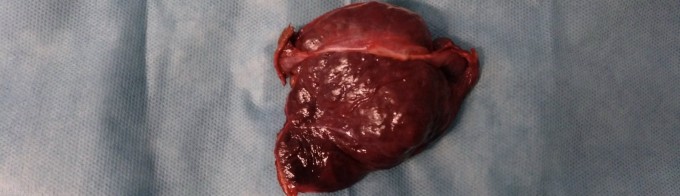 tumor hepatico incidental pieza