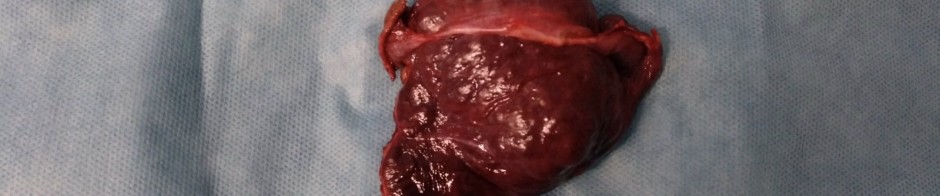 tumor hepatico incidental pieza