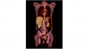 suprarrenal metastasis