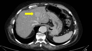 TAC hepatocarcinoma