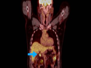 ganglionar recurrence after gastrectomy