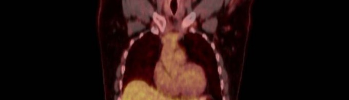 ganglionar recurrence after gastrectomy