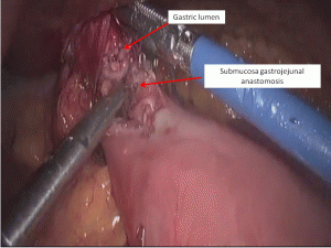 submucosa anastomosis