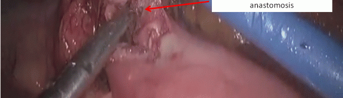 submucosa anastomosis