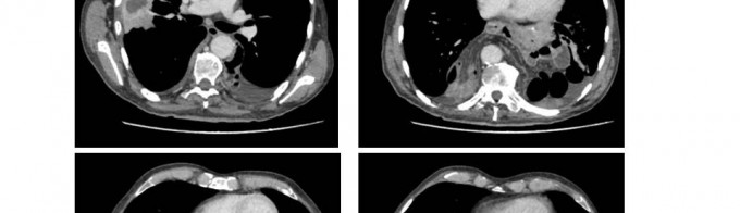 Laparoscopic repair of jejunal transthoracic herniation after total 5