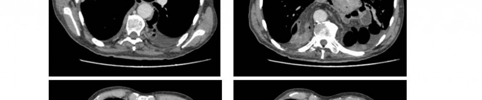 Laparoscopic repair of jejunal transthoracic herniation after total 5