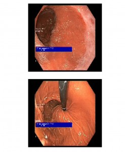 banda gástrica endoscopia