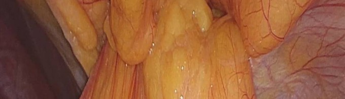 Hernia de Morgagni foto