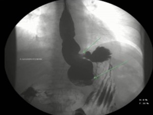 Fistula gastrogastrica Masson